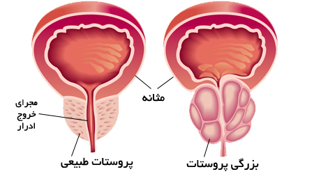 سرطان پروستات چیست؟(ادامه... کلیک کنید)