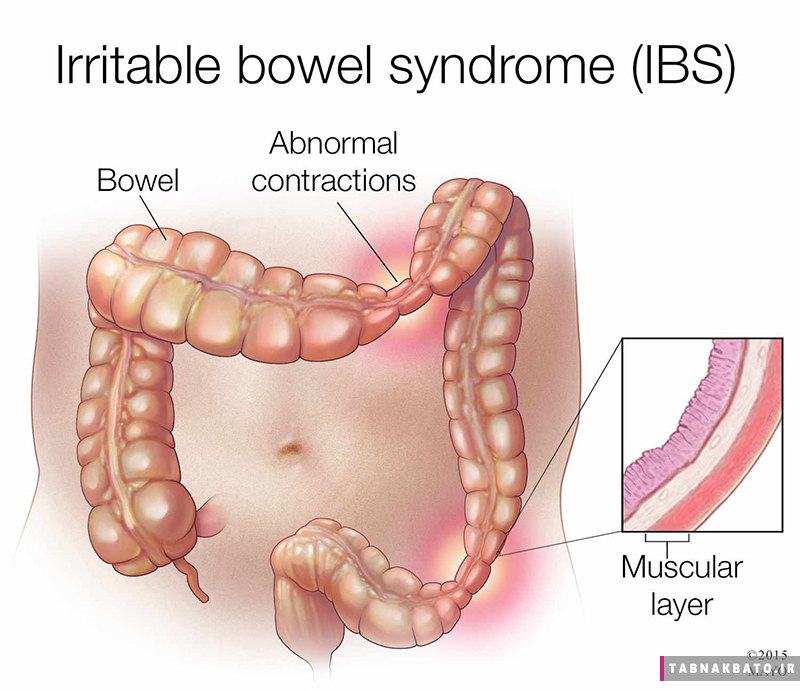 سندروم روده تحریک پذیر(ادامه... کیلیک کنید)