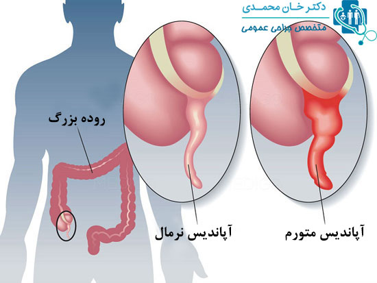 آپاندیسیت چیست ؟(ادامه ... کلیک کنید.)